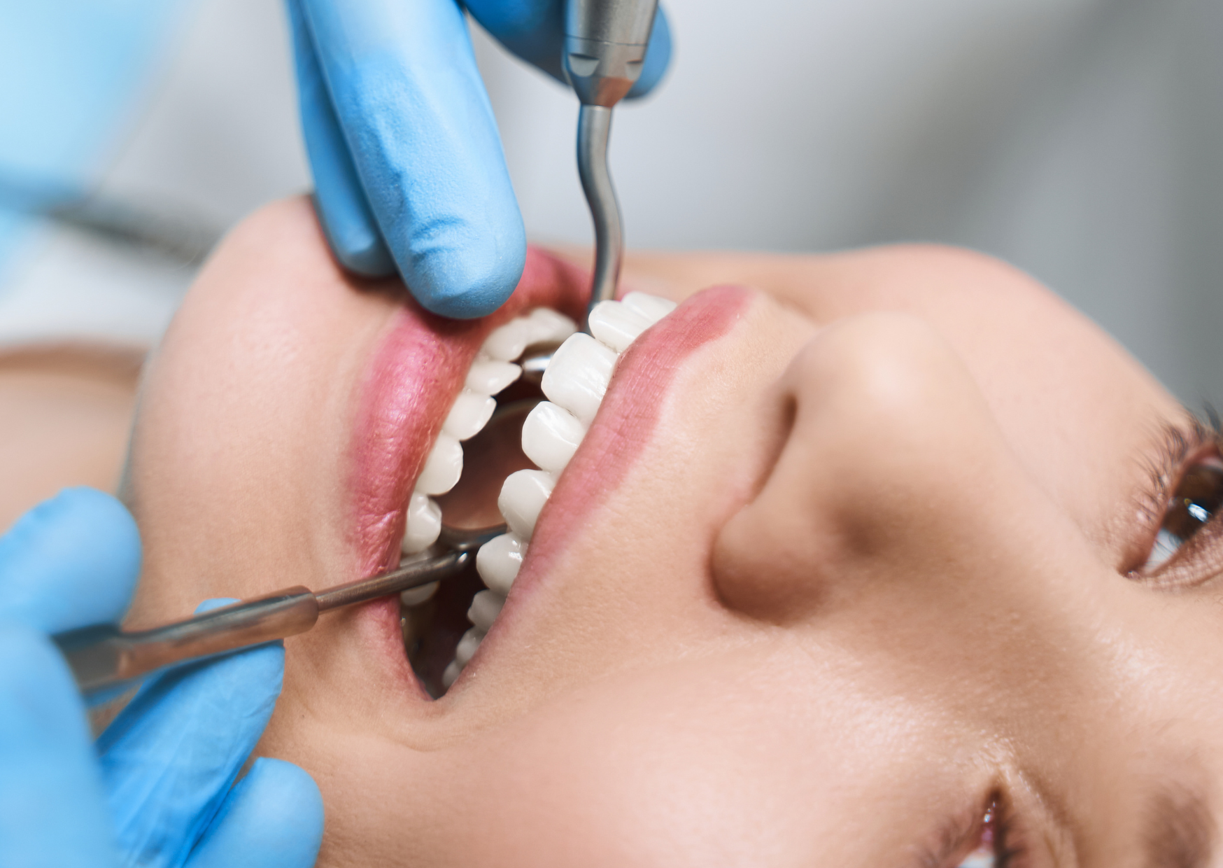 root canal 3