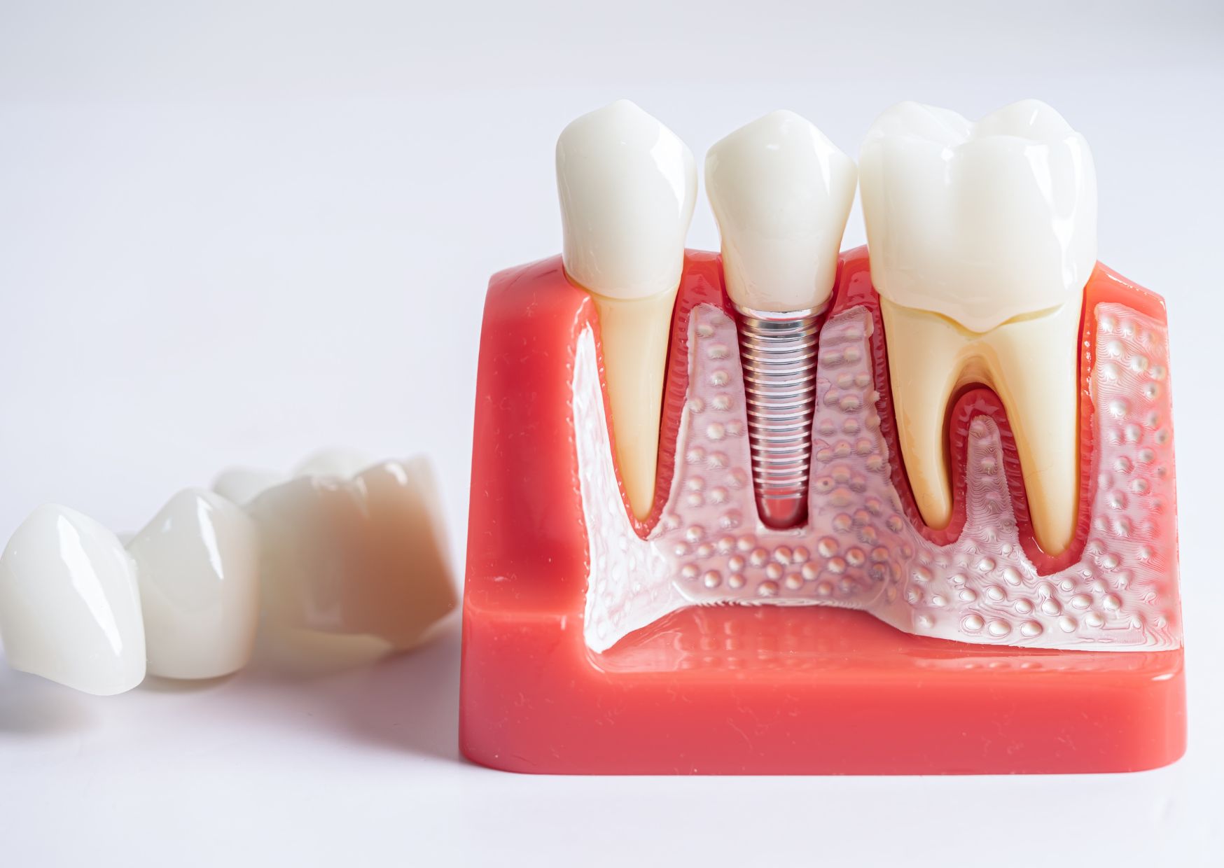 root canal 4