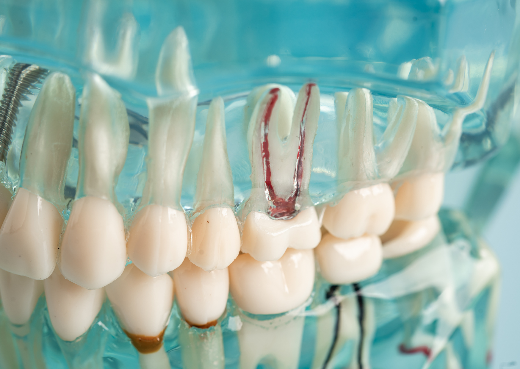 root canal 6